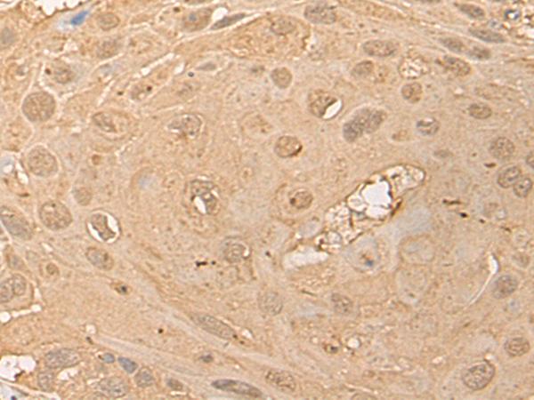 CPNE3 Antibody - Immunohistochemistry of paraffin-embedded Human esophagus cancer tissue  using CPNE3 Polyclonal Antibody at dilution of 1:40(×200)