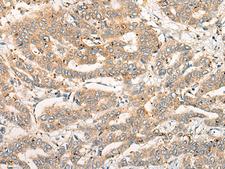 CPNE4 Antibody - Immunohistochemistry of paraffin-embedded Human liver cancer tissue  using CPNE4 Polyclonal Antibody at dilution of 1:40(×200)