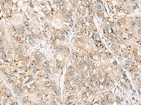 CPNE4 Antibody - Immunohistochemistry of paraffin-embedded Human gastric cancer tissue  using CPNE4 Polyclonal Antibody at dilution of 1:40(×200)