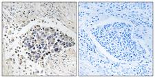 CPNE8 / Copine VIII Antibody - Immunohistochemistry analysis of paraffin-embedded human lung carcinoma tissue, using CPNE8 Antibody. The picture on the right is blocked with the synthesized peptide.