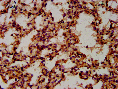 CPNE8 / Copine VIII Antibody - Immunohistochemistry Dilution at 1:600 and staining in paraffin-embedded human lung tissue performed on a Leica BondTM system. After dewaxing and hydration, antigen retrieval was mediated by high pressure in a citrate buffer (pH 6.0). Section was blocked with 10% normal Goat serum 30min at RT. Then primary antibody (1% BSA) was incubated at 4°C overnight. The primary is detected by a biotinylated Secondary antibody and visualized using an HRP conjugated SP system.