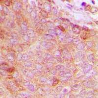 CPNE8 / Copine VIII Antibody - Immunohistochemical analysis of Copine 8 staining in human breast cancer formalin fixed paraffin embedded tissue section. The section was pre-treated using heat mediated antigen retrieval with sodium citrate buffer (pH 6.0). The section was then incubated with the antibody at room temperature and detected with HRP and DAB as chromogen. The section was then counterstained with hematoxylin and mounted with DPX.