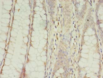 CPNE9 Antibody - Immunohistochemistry of paraffin-embedded human colon cancer using antibody at 1:100 dilution.