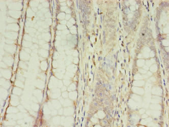 CPNE9 Antibody - Immunohistochemistry of paraffin-embedded human colon cancer using CPNE9 Antibody at dilution of 1:100