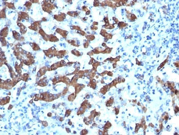 CPS1 Antibody - Formalin-fixed, paraffin-embedded human hepatocellular carcinoma stained with CPS1 antibody (CPS1/1022).  This image was taken for the unmodified form of this product. Other forms have not been tested.