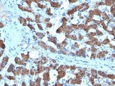 CPS1 Antibody - Formalin-fixed, paraffin-embedded human hepatocellular carcinoma stained with CPS1 antibody (SPM615).  This image was taken for the unmodified form of this product. Other forms have not been tested.