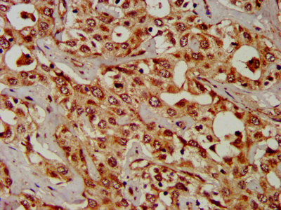 CPS1 Antibody - Immunohistochemistry image at a dilution of 1:300 and staining in paraffin-embedded human liver cancer performed on a Leica BondTM system. After dewaxing and hydration, antigen retrieval was mediated by high pressure in a citrate buffer (pH 6.0) . Section was blocked with 10% normal goat serum 30min at RT. Then primary antibody (1% BSA) was incubated at 4 °C overnight. The primary is detected by a biotinylated secondary antibody and visualized using an HRP conjugated SP system.
