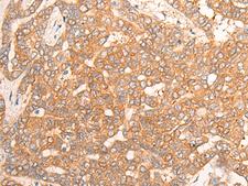 CPS1 Antibody - Immunohistochemistry of paraffin-embedded Human liver cancer tissue  using CPS1 Polyclonal Antibody at dilution of 1:35(×200)