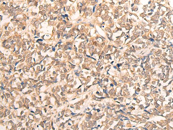 CPS1 Antibody - Immunohistochemistry of paraffin-embedded Human lung cancer tissue  using CPS1 Polyclonal Antibody at dilution of 1:35(×200)