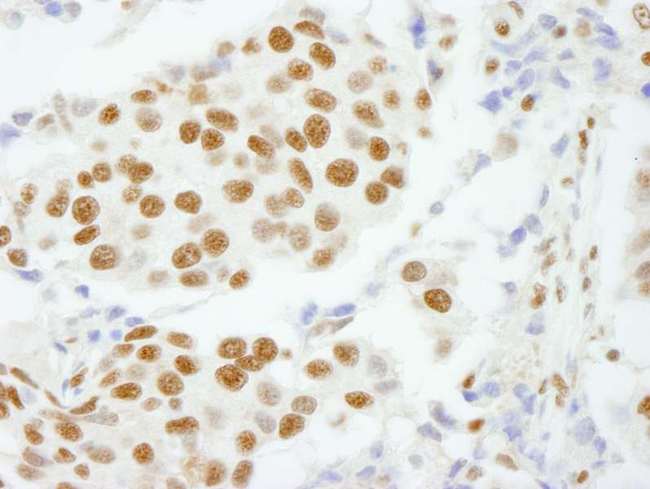 CPSF160 / CPSF1 Antibody - Detection of Human CPSF160 by Immunohistochemistry. Sample: FFPE section of human breast carcinoma. Antibody: Affinity purified rabbit anti-CPSF160 used at a dilution of 1:100.