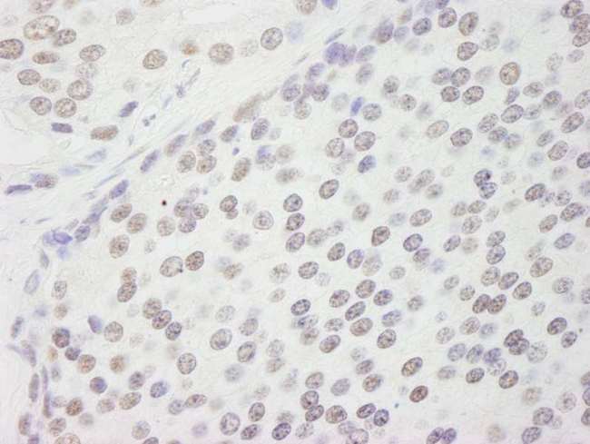 CPSF160 / CPSF1 Antibody - Detection of Human CPSF160 by Immunohistochemistry. Sample: FFPE section of human prostate carcinoma. Antibody: Affinity purified rabbit anti-CPSF160 used at a dilution of 1:500.