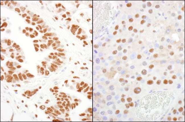 CPSF160 / CPSF1 Antibody - Detection of Human and Mouse CPSF160 by Immunohistochemistry. Sample: FFPE section of human ovarian carcinoma (left) and mouse renal cell carcinoma (right). Antibody: Affinity purified rabbit anti-CPSF160 used at a dilution of 1:200 (1 ug/ml). Detection: DAB.