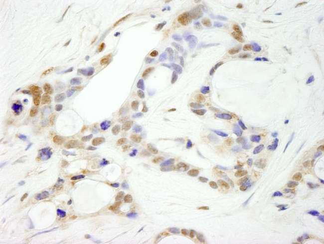 CPSF2 Antibody - Detection of Human CPSF100 Immunohistochemistry. Sample: FFPE section of human ovarian carcinoma. Antibody: Affinity purified rabbit anti-CPSF100 used at a dilution of 1:250.