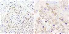 CPSF2 Antibody - Detection of Human and Mouse CPSF100 by Immunohistochemistry. Sample: FFPE section of human pancreatic islet cell tumor (left) and mouse teratoma (right). Antibody: Affinity purified rabbit anti-CPSF100 used at a dilution of 1:200 (1 ug/ml). Detection: DAB.