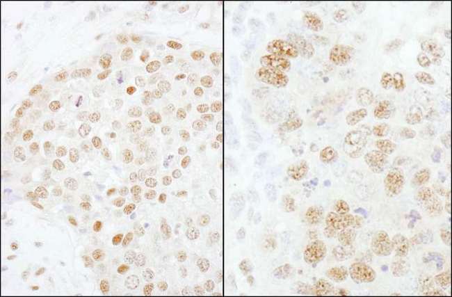 CPSF3 / CPSF Antibody - Detection of Human and Mouse CPSF73 by Immunohistochemistry. Sample: FFPE section of human breast carcinoma (left) and mouse teratoma (right). Antibody: Affinity purified rabbit anti-CPSF73 used at a dilution of 1:200 (1 ug/ml). Detection: DAB.