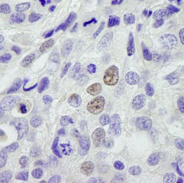 CPSF3L Antibody - Detection of Human INT11 by Immunohistochemistry. Sample: FFPE section of human breast carcinoma. Antibody: Affinity purified rabbit anti-INT11 used at a dilution of 1:250.