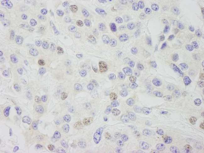 CPSF3L Antibody - Detection of Human INT11 by Immunohistochemistry. Sample: FFPE section of human breast carcinoma. Antibody: Affinity purified rabbit anti-INT11 used at a dilution of 1:1000 (1 Detection: DAB.
