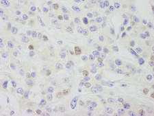 CPSF3L Antibody - Detection of Human INT11 by Immunohistochemistry. Sample: FFPE section of human breast carcinoma. Antibody: Affinity purified rabbit anti-INT11 used at a dilution of 1:1000 (1 Detection: DAB.