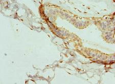 CPSF3L Antibody - Immunohistochemistry of paraffin-embedded human breast cancer at dilution 1:100