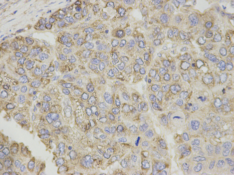 CPT1A Antibody - Immunohistochemistry of paraffin-embedded human liver cancer using CPT1A antibody at dilution of 1:200 (400x lens).