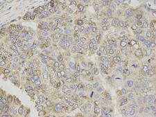 CPT1A Antibody - Immunohistochemistry of paraffin-embedded human liver cancer using CPT1A antibody at dilution of 1:200 (400x lens).