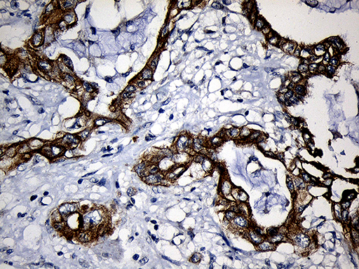 CPT1B Antibody - Immunohistochemical staining of paraffin-embedded Carcinoma of Human pancreas tissue using anti-CPT1B mouse monoclonal antibody. (Heat-induced epitope retrieval by 1mM EDTA in 10mM Tris buffer. (pH8.5) at 120°C for 3 min. (1:500)