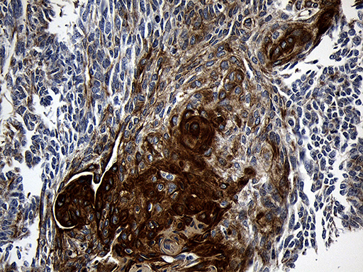 CPT1B Antibody - Immunohistochemical staining of paraffin-embedded Adenocarcinoma of Human endometrium tissue using anti-CPT1B mouse monoclonal antibody. (Heat-induced epitope retrieval by 1mM EDTA in 10mM Tris buffer. (pH8.5) at 120°C for 3 min. (1:500)