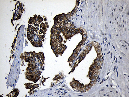 CPT1B Antibody - Immunohistochemical staining of paraffin-embedded Carcinoma of Human prostate tissue using anti-CPT1B mouse monoclonal antibody. (Heat-induced epitope retrieval by 1mM EDTA in 10mM Tris buffer. (pH8.5) at 120°C for 3 min. (1:500)