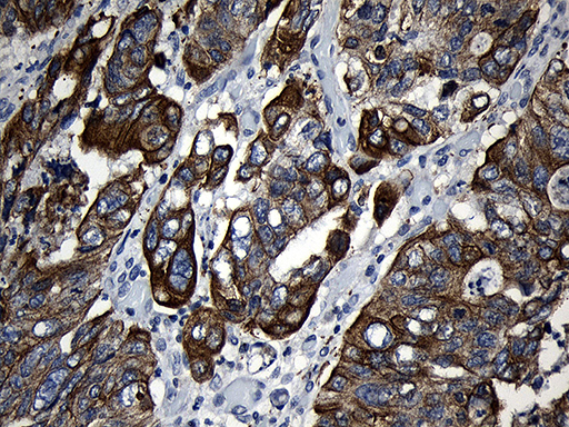 CPT1B Antibody - Immunohistochemical staining of paraffin-embedded Adenocarcinoma of Human colon tissue using anti-CPT1B mouse monoclonal antibody. (Heat-induced epitope retrieval by 1mM EDTA in 10mM Tris buffer. (pH8.5) at 120°C for 3 min. (1:500)
