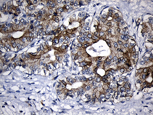 CPT1B Antibody - Immunohistochemical staining of paraffin-embedded Carcinoma of Human liver tissue using anti-CPT1B mouse monoclonal antibody. (Heat-induced epitope retrieval by 1mM EDTA in 10mM Tris buffer. (pH8.5) at 120°C for 3 min. (1:500)