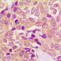 CPT1B Antibody - Immunohistochemical analysis of CPT1B staining in human breast cancer formalin fixed paraffin embedded tissue section. The section was pre-treated using heat mediated antigen retrieval with sodium citrate buffer (pH 6.0). The section was then incubated with the antibody at room temperature and detected using an HRP-conjugated compact polymer system. DAB was used as the chromogen. The section was then counterstained with hematoxylin and mounted with DPX.