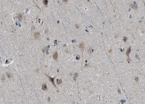 CPT1C Antibody - 1:100 staining human brain tissue by IHC-P. The tissue was formaldehyde fixed and a heat mediated antigen retrieval step in citrate buffer was performed. The tissue was then blocked and incubated with the antibody for 1.5 hours at 22°C. An HRP conjugated goat anti-rabbit antibody was used as the secondary.