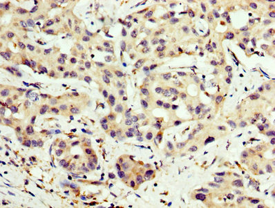 CPT2 Antibody - Immunohistochemistry image at a dilution of 1:200 and staining in paraffin-embedded human liver cancer performed on a Leica BondTM system. After dewaxing and hydration, antigen retrieval was mediated by high pressure in a citrate buffer (pH 6.0) . Section was blocked with 10% normal goat serum 30min at RT. Then primary antibody (1% BSA) was incubated at 4 °C overnight. The primary is detected by a biotinylated secondary antibody and visualized using an HRP conjugated SP system.