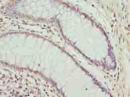 CPXCR1 / CT77 Antibody - Immunohistochemistry of paraffin-embedded human colon cancer using antibody at dilution of 1:100.