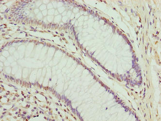 CPXCR1 / CT77 Antibody - Immunohistochemistry of paraffin-embedded human colon cancer using CPXCR1 Antibody at dilution of 1:100