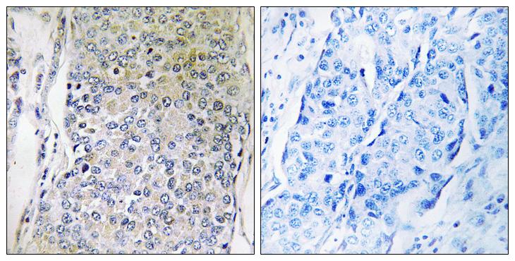 CPXM2 Antibody - Peptide - + Immunohistochemistry analysis of paraffin-embedded human breast carcinoma tissue using CPXM2 antibody.