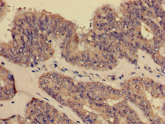 CR1 / CD35 Antibody - Immunohistochemistry of paraffin-embedded human endometrial cancer at dilution of 1:100