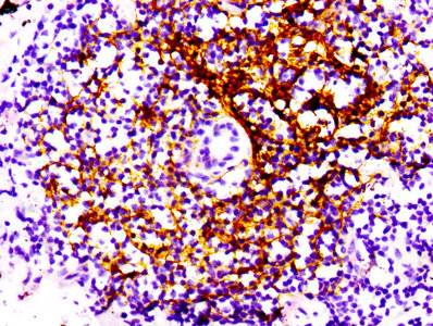 CR2 / CD21 Antibody - Immunohistochemistry Dilution at 1:100 and staining in paraffin-embedded human lung cancer performed on a Leica BondTM system. After dewaxing and hydration, antigen retrieval was mediated by high pressure in a citrate buffer (pH 6.0). Section was blocked with 10% normal Goat serum 30min at RT. Then primary antibody (1% BSA) was incubated at 4°C overnight. The primary is detected by a biotinylated Secondary antibody and visualized using an HRP conjugated SP system.