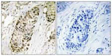 CR6 / GADD45G Antibody - Immunohistochemistry analysis of paraffin-embedded human lung carcinoma tissue, using GA45G Antibody. The picture on the right is blocked with the synthesized peptide.