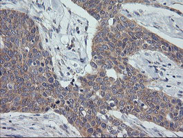 CR6 / GADD45G Antibody - IHC of paraffin-embedded Carcinoma of Human bladder tissue using anti-GADD45G mouse monoclonal antibody.