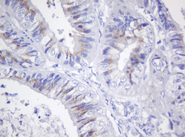 CR6 / GADD45G Antibody - IHC of paraffin-embedded Adenocarcinoma of Human endometrium tissue using anti-GADD45G mouse monoclonal antibody. (Heat-induced epitope retrieval by 10mM citric buffer, pH6.0, 120°C for 3min).