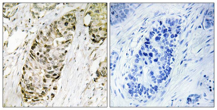 CR6 / GADD45G Antibody - Peptide - + Immunohistochemistry analysis of paraffin-embedded human lung carcinoma tissue using GA45G antibody.