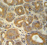 CRABP1 / CRABP Antibody - CRABP1 Antibody immunohistochemistry of formalin-fixed and paraffin-embedded human prostate carcinoma followed by peroxidase-conjugated secondary antibody and DAB staining.