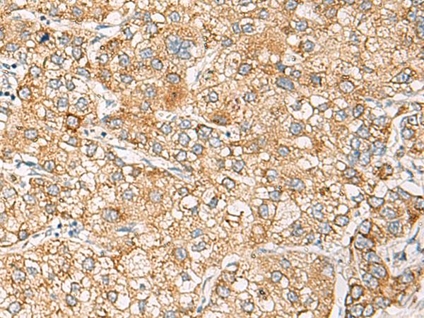 CRABP1 / CRABP Antibody - Immunohistochemistry of paraffin-embedded Human liver cancer tissue  using CRABP1 Polyclonal Antibody at dilution of 1:120(×200)