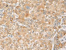 CRABP1 / CRABP Antibody - Immunohistochemistry of paraffin-embedded Human liver cancer tissue  using CRABP1 Polyclonal Antibody at dilution of 1:120(×200)