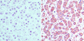 CRABP2 Antibody - IHC of CRABP2 in formalin-fixed, paraffin-embedded human liver tissue using an isotype control (left) and Polyclonal Antibody to CRABP2 (right) at 5 ug/ml.