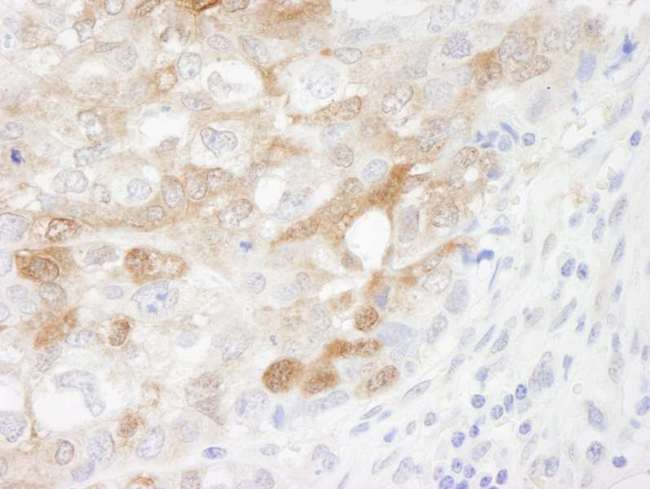 CRABP2 Antibody - Detection of Human CRABP2 by Immunohistochemistry. Sample: FFPE section of human breast adenocarcinoma. Antibody: Affinity purified rabbit anti-CRABP2 used at a dilution of 1:500.