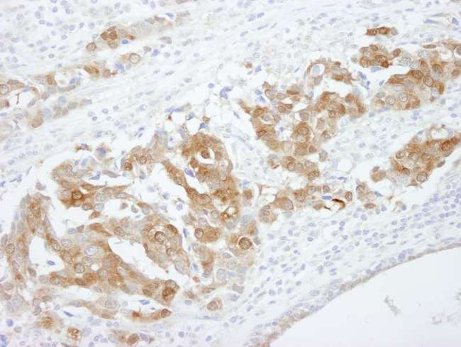CRABP2 Antibody - Detection of Human CRABP2 by Immunohistochemistry. Sample: FFPE section of human breast adenocarcinoma. Antibody: Affinity purified rabbit anti-CRABP2 used at a dilution of 1:100.