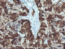 CRABP2 Antibody - IHC of paraffin-embedded Adenocarcinoma of Human ovary tissue using anti-CRABP2 mouse monoclonal antibody.