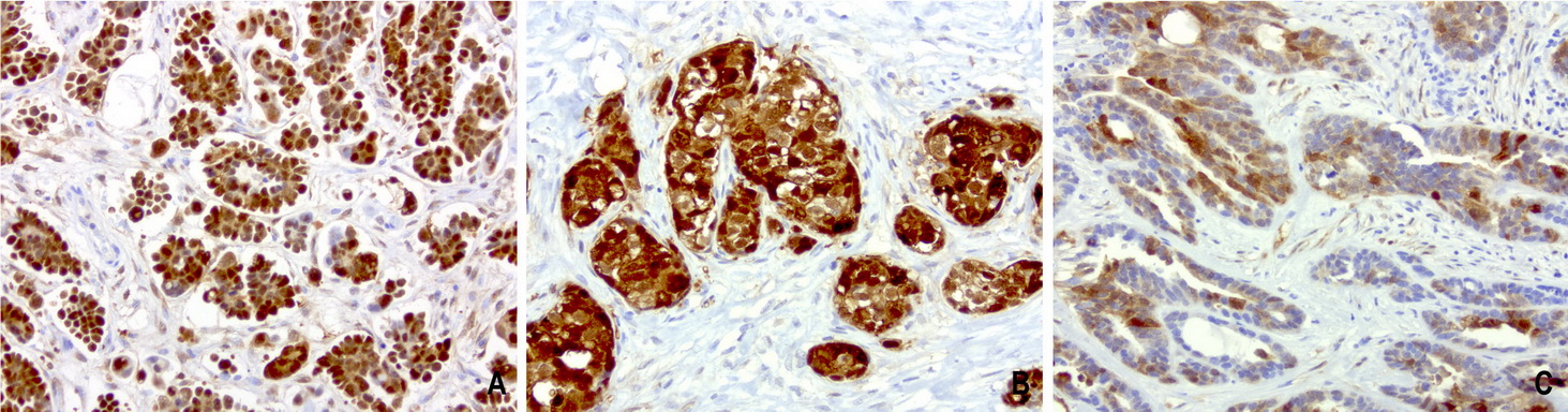 CRABP2 Antibody - Immunohistochemical staining of paraffin-embedded human ovarian carcinoma using anti-CRABB2 mouse monoclonal antibody at 1:200 dilution of 1mg/mL using Polink2 Broad HRP DAB for detection.requires HIER with citrate pH 6.0 at 110C for 3 min using pressure chamber/cooker. The composit of 3 ovarain tumors shows strong nuclear, cytoplasmic, and mebraneous staining in the tumor cells.
